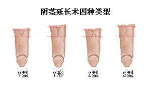 新韓式微創(chuàng)陰莖延長(zhǎng)術(shù)